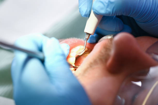 Best Emergency Root Canal Treatment in Camp Springs, MD